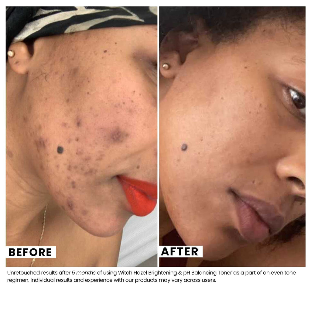 Brightening & pH Balancing Witch Hazel Toner